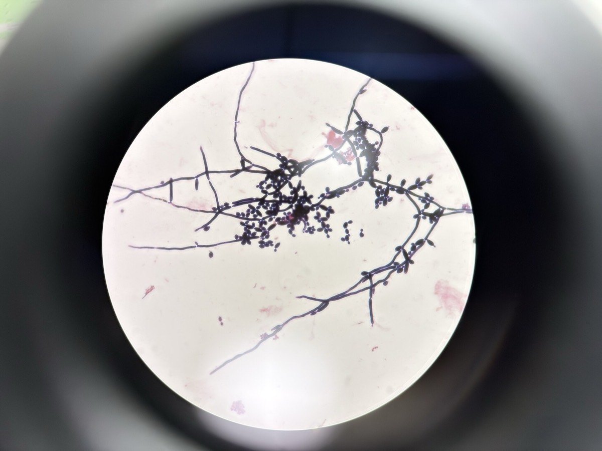Levaduras con pseudohifas en Gram de esputo