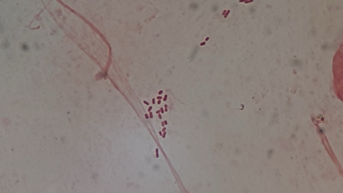 Frotis de esputo con bacilos gramnegativos y fondo inflamatorio