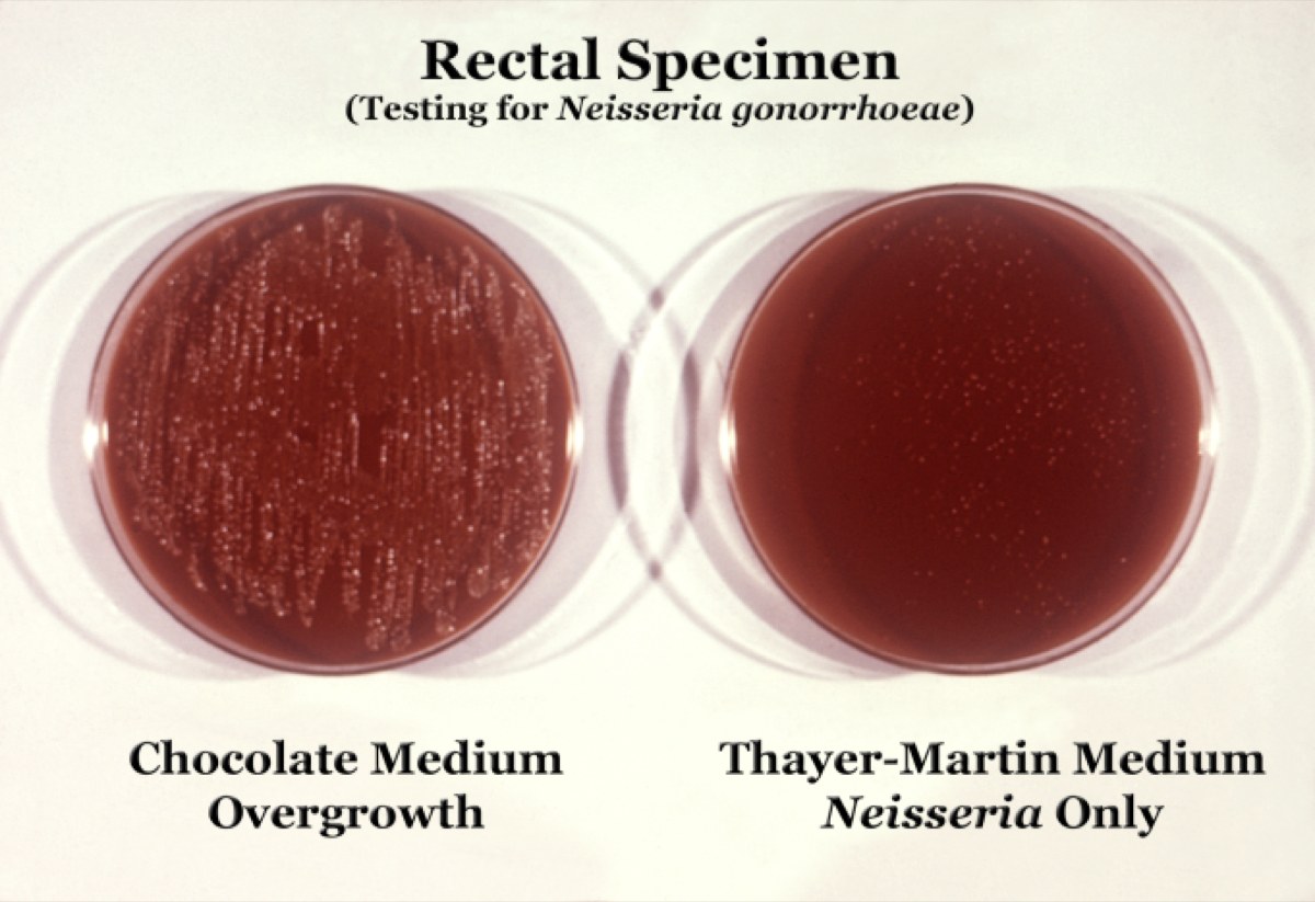 Comparación de agar chocolate con sobrecrecimiento y Thayer-Martin con solo Neisseria