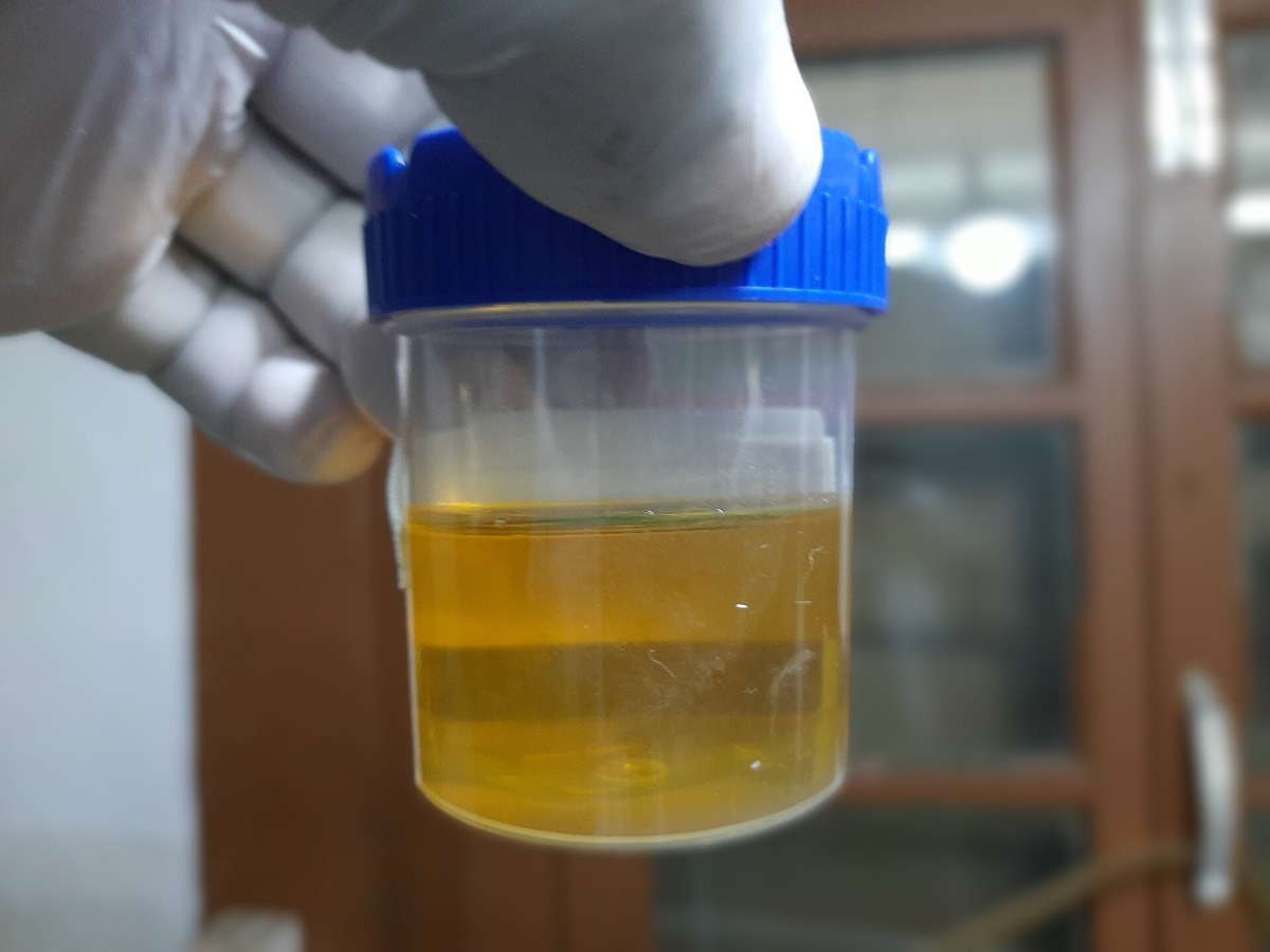 Frasco estéril con muestra de orina para urocultivo